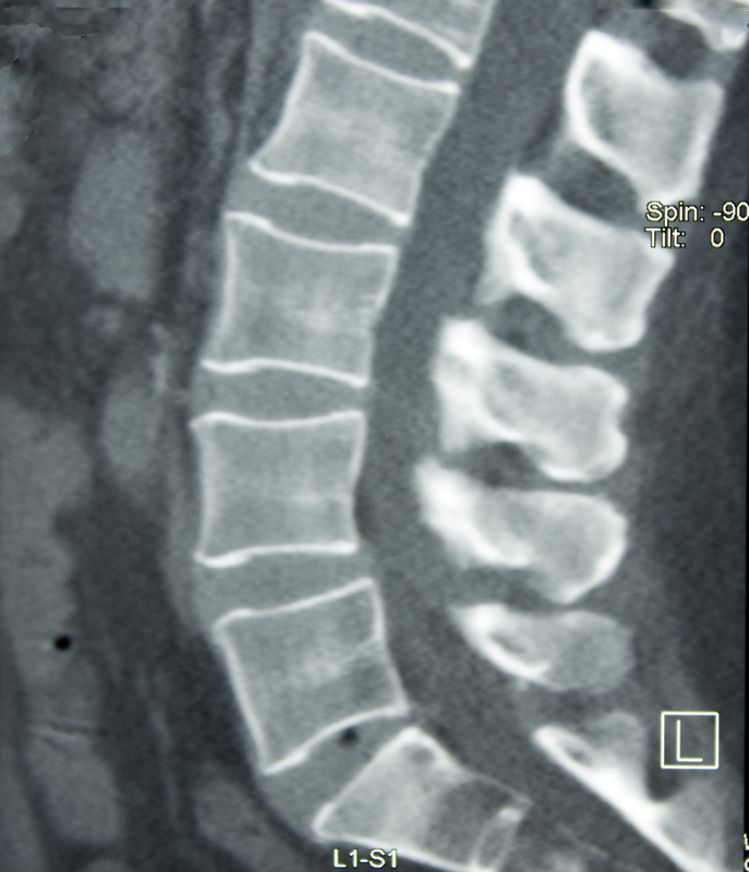 Cervical, Thoracic, Lumbar Transforaminal Epidural Cortisone Injections - Trinity Surgery Center 2