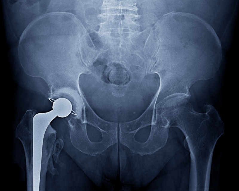 Sacroiliac Joint Injections - Trinity Surgery Center-2